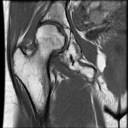 Acetabular Intraosseous Lipoma Image Radiopaedia Org