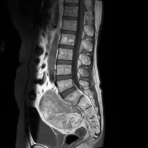Extramedullary Hematopoiesis Presacral Soft Tissue Mass Image
