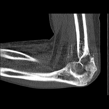 Post Traumatic Heterotopic Ossification Elbow Radiology Case