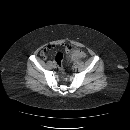 Uncomplicated Sigmoid Diverticulitis Radiology Case Radiopaedia Org