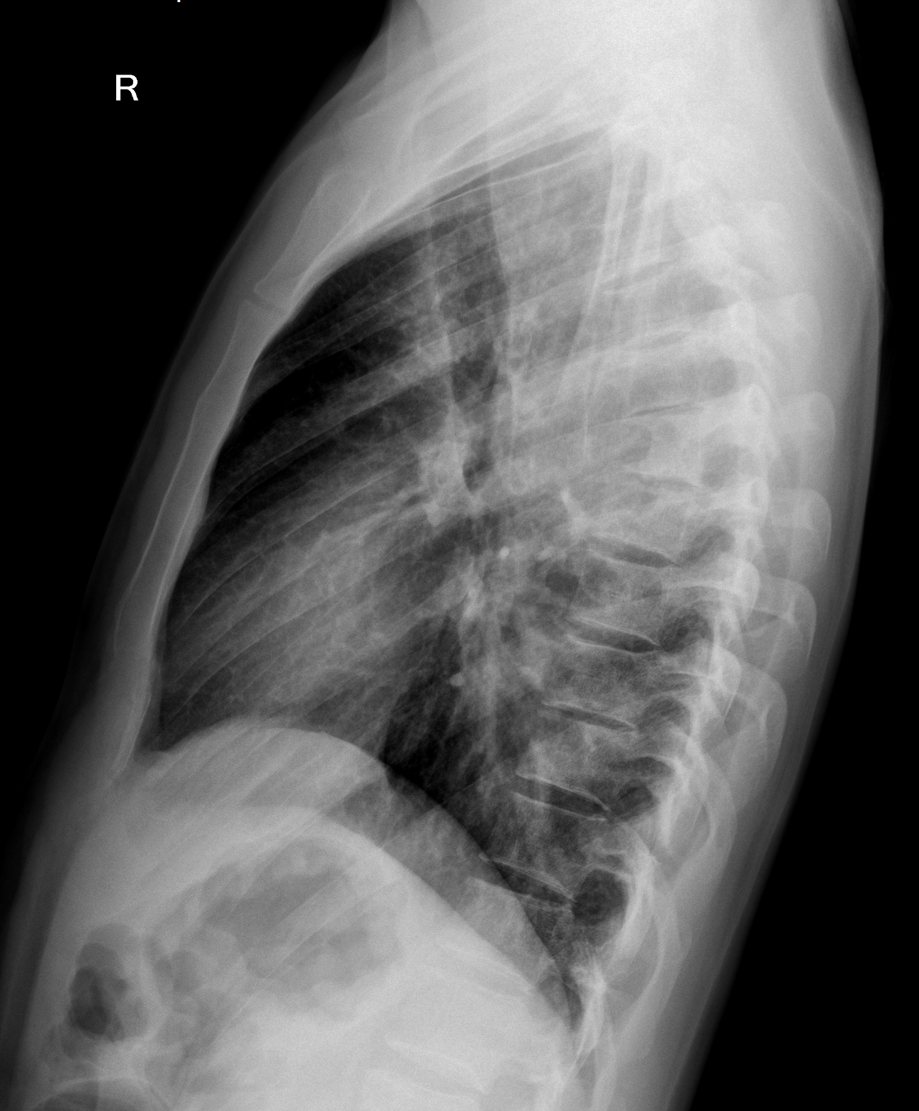 Pott S Disease Image Radiopaedia Org