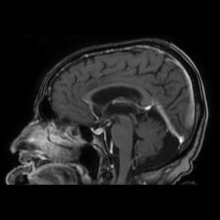 Acoustic Neuroma Intracanalicular Image Radiopaedia Org