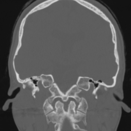 Duplication Of The Pituitary Gland Plus Syndrome Radiology Case