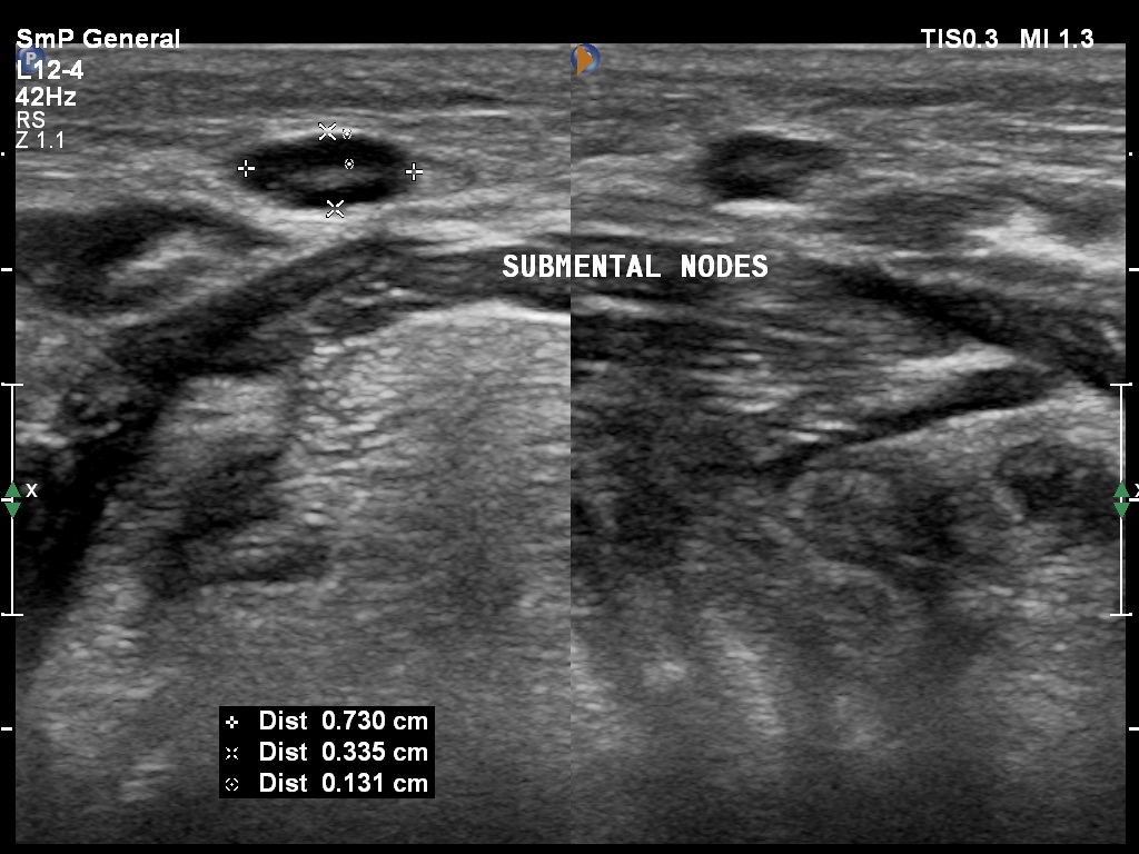 Acute Sialadenitis Image Radiopaedia Org