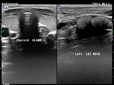 Acute Sialadenitis Image Radiopaedia Org