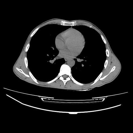 Pancoast Tumor Radiology Case Radiopaedia Org