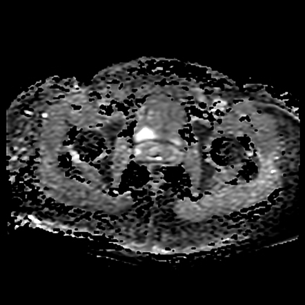 Gartner Duct Cyst Image Radiopaedia Org