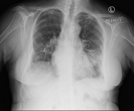 Lung Cancer Radiology Case Radiopaedia Org