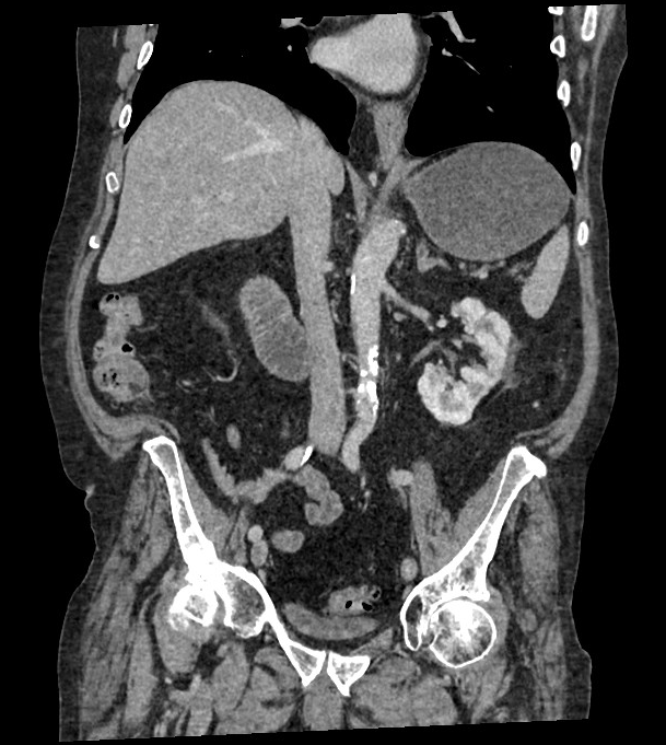 Gallstone Ileus Radiolucent Gallstone Image Radiopaedia Org