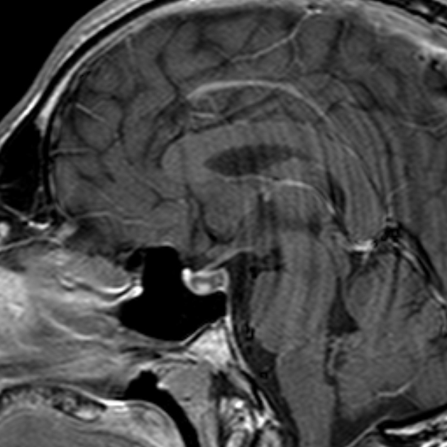 Rathke Cleft Cyst With Intracystic Nodules Image Radiopaedia Org