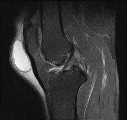 Prepatellar Bursitis Image Radiopaedia Org