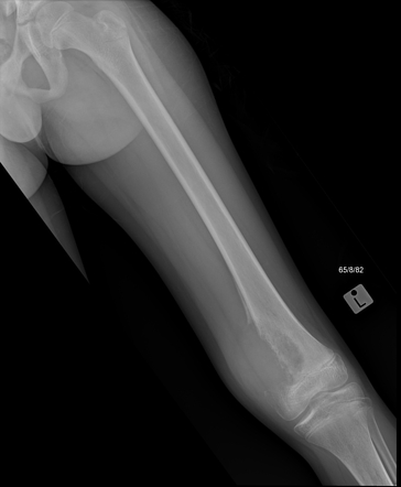 Osteosarcoma Radiology Case Radiopaedia Org