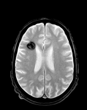 Cavernoma Frontal Radiology Case Radiopaedia Org