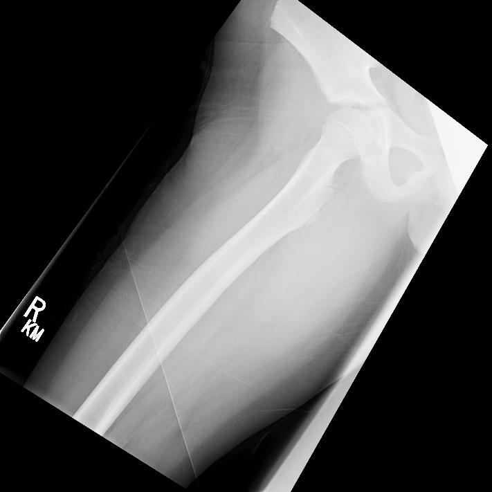 Osteochondroma Image Radiopaedia Org