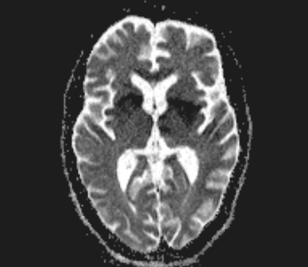 Diffuse Axonal Injury With Bilateral Hypertrophic Olivary Degeneration