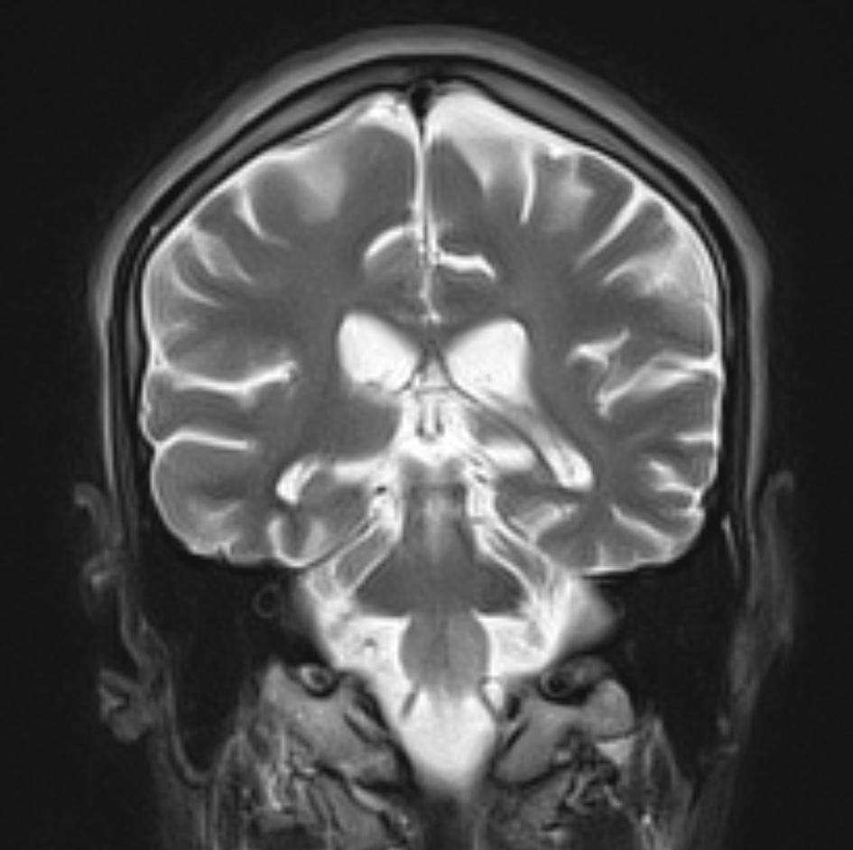 Diffuse Axonal Injury With Bilateral Hypertrophic Olivary Degeneration