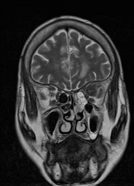 Rhino Orbito Cerebral Mucormycosis Image Radiopaedia Org