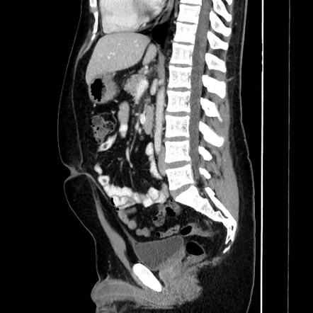 Normal Ct Of The Abdomen And Pelvis Male Image Radiopaedia Org