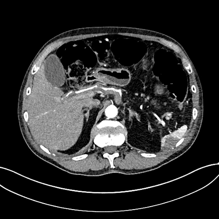 Figure From Celiac Artery Dissection And Retroperitoneal Hemorrhage My XXX Hot Girl