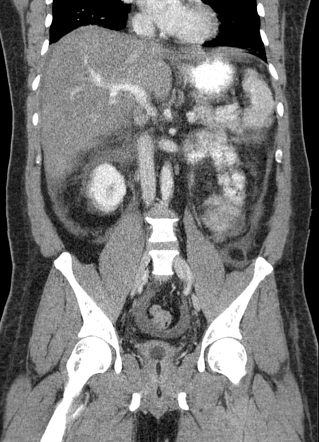 Acute Hepatitis Dengue Viral Hepatitis Radiology Case Radiopaedia Org