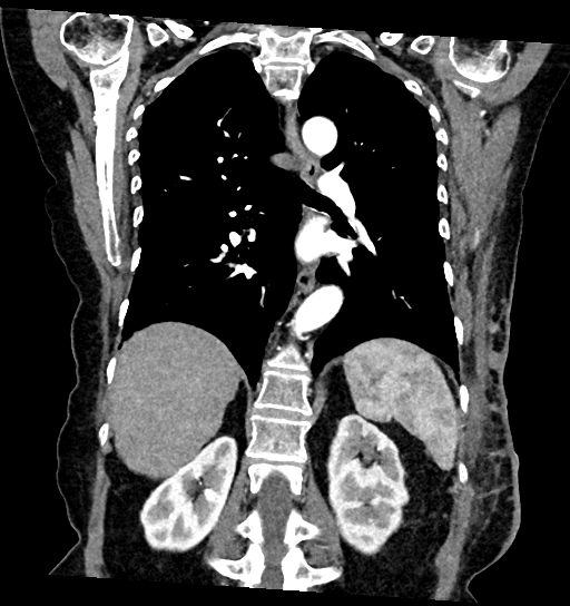 Cutaneous Metastases Breast Cancer Image Radiopaedia Org