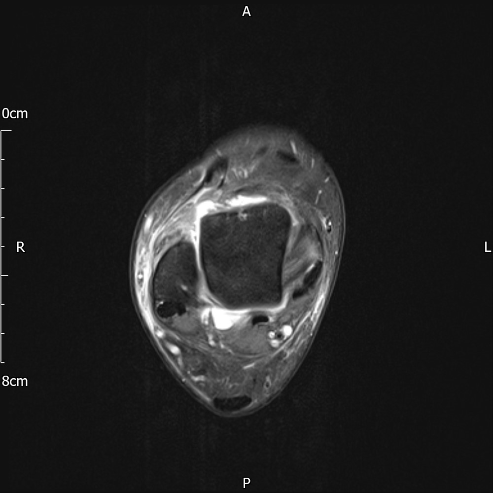 Acute Complete Anterior Talofibular Ligament Tear Image Radiopaedia Org