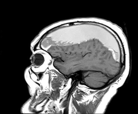 Subacute Subdural Haematoma Radiology Case Radiopaedia Org