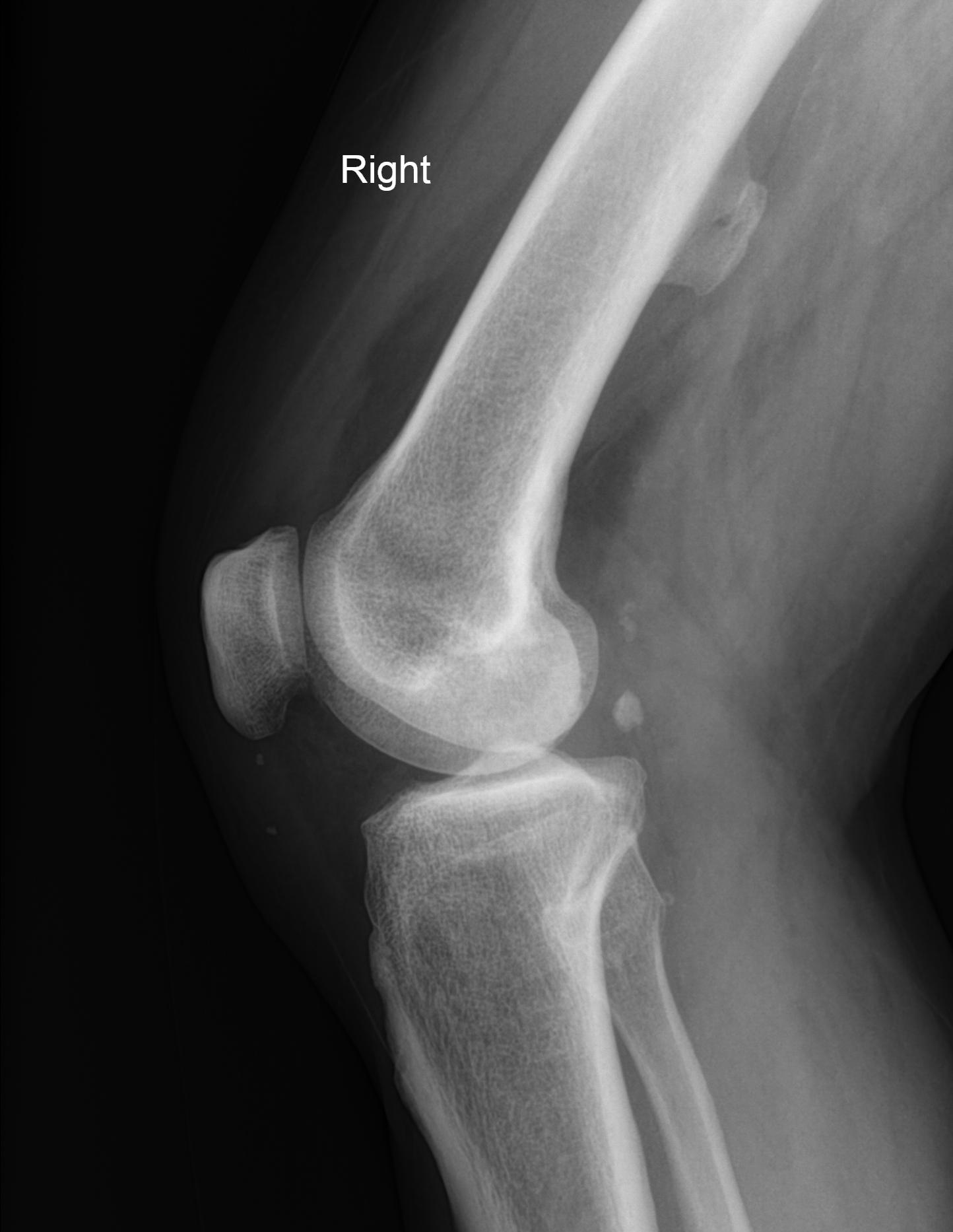 Sessile Osteochondroma Image Radiopaedia Org