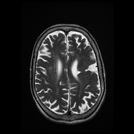 Schizencephaly Closed Lip Radiology Case Radiopaedia Org