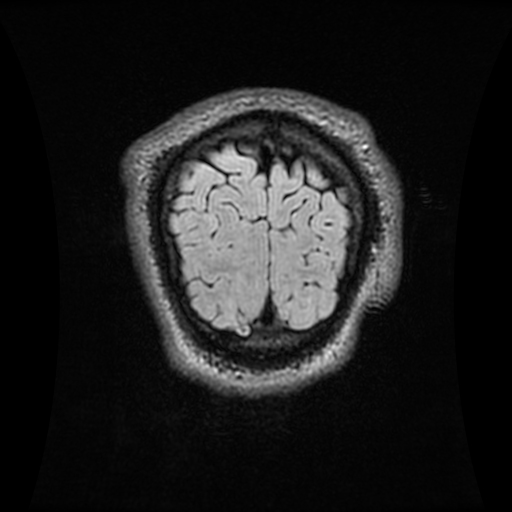 Quadrigeminal Cistern Lipoma With Occipital Encephalocele Image