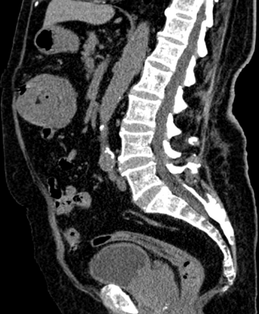 Colocolic Intussusception Image Radiopaedia Org