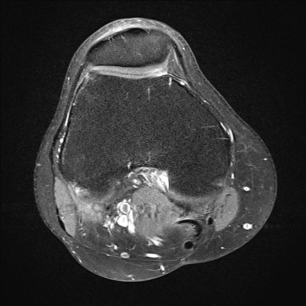 Localized Tenosynovial Giant Cell Tumor Knee Image Radiopaedia Org