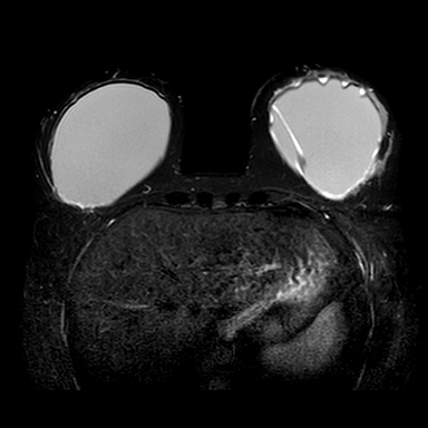 Intracapsular Breast Implant Rupture Image Radiopaedia Org