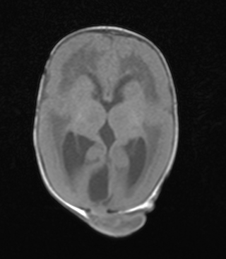 Lissencephaly Type II Image Radiopaedia Org