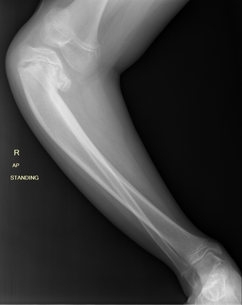 Blount Disease Radiology Case Radiopaedia Org