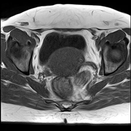 Diffuse Uterine Adenomyosis With Ovarian Endometrioma And Deep