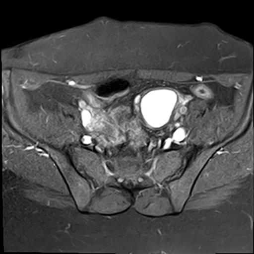 Diffuse Uterine Adenomyosis With Ovarian Endometrioma And Deep