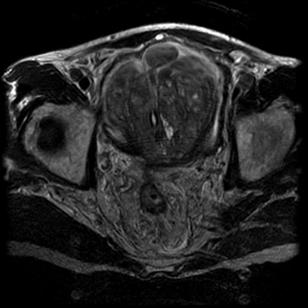 Prostate Sarcoma Radiology Reference Article Radiopaedia Org