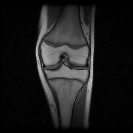 Sinding Larsen Johansson Disease Image Radiopaedia Org