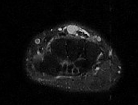 Intratendinous Ganglion Cyst Of The Third Extensor Digitorum Tendon