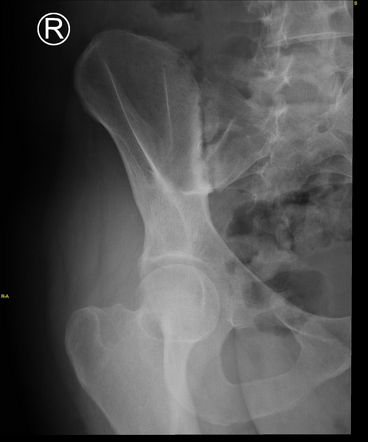 Sacroiliitis Radiology Case Radiopaedia Org