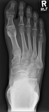 Middle Toe Phalanx Fracture Image Radiopaedia Org