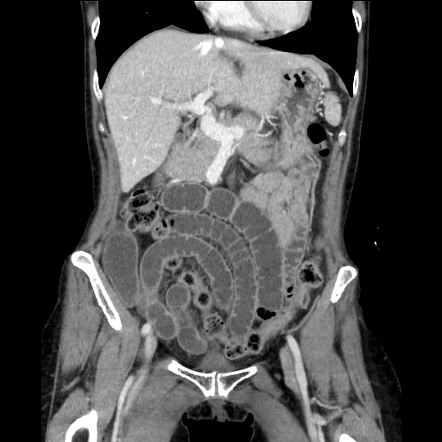 Radiation Induced Enteritis Resulting In Small Bowel Obstruction