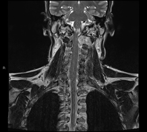 Spinal Schwannoma Cervical Image Radiopaedia Org