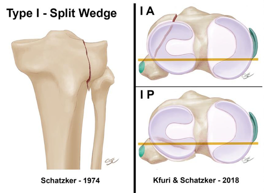 Kfuri And Schatzker Classification Of Tibial Plateau Fractures Image Radiopaedia Org