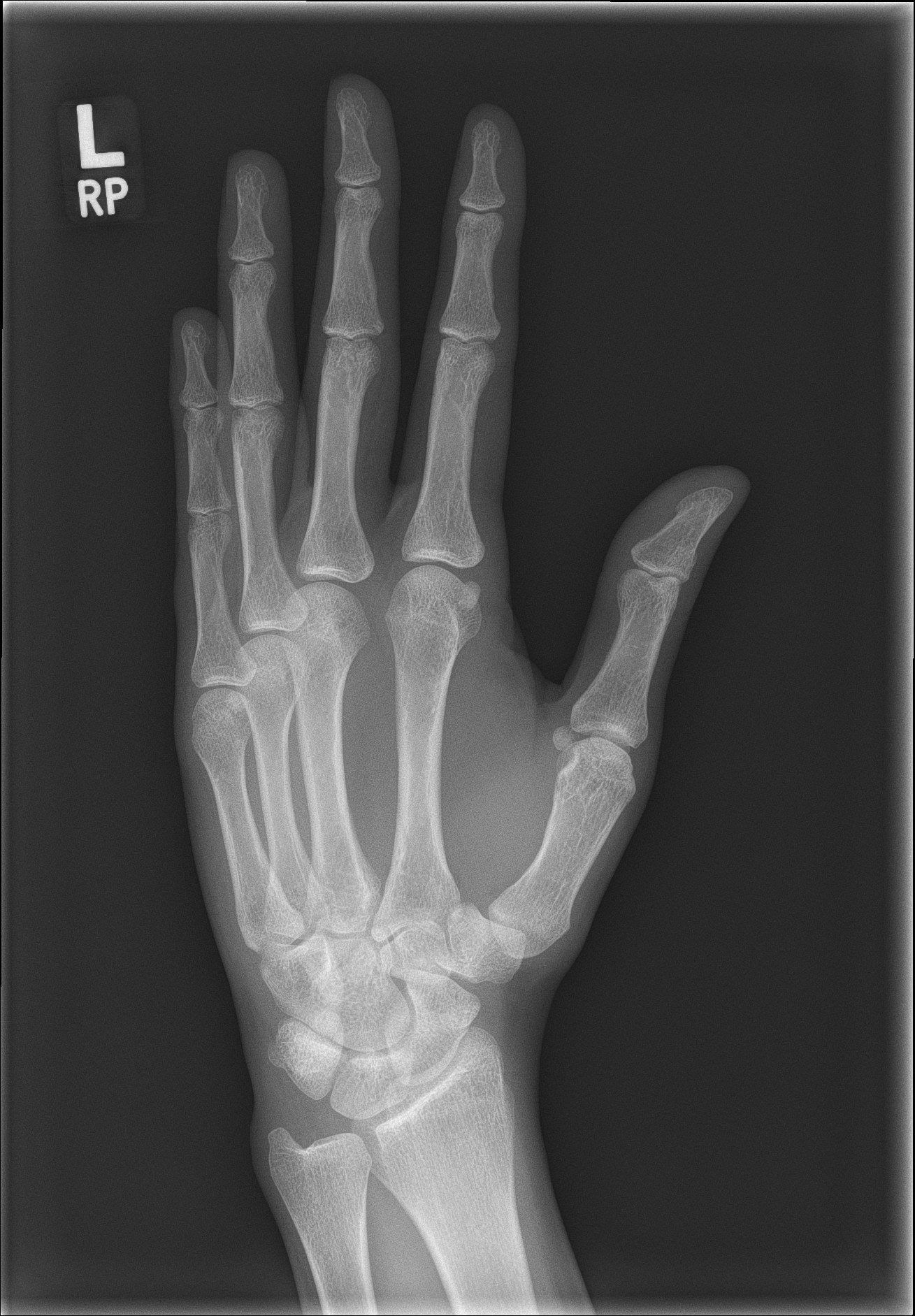 Metacarpal Head Fracture Image Radiopaedia Org