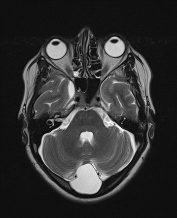 Arachnoid Cyst Of Posterior Fossa Radiology Case Radiopaedia Org