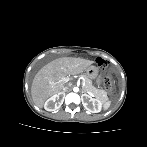 Ovarian Hyperstimulation Syndrome Image Radiopaedia Org