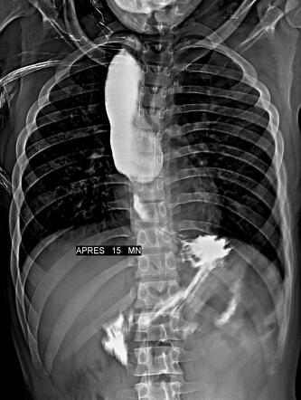 Peptic Esophageal Stricture Radiology Case Radiopaedia Org