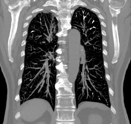 Pulmonary Cement Embolization After Vertebroplasty Image